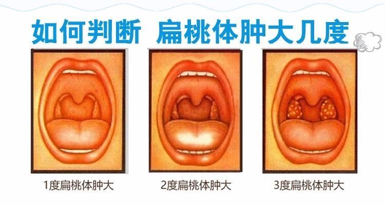 泰腺样体肥大贴儿童睡觉张嘴呼吸打呼噜贴扁桃体肿大喉咙发炎贴腺样轻