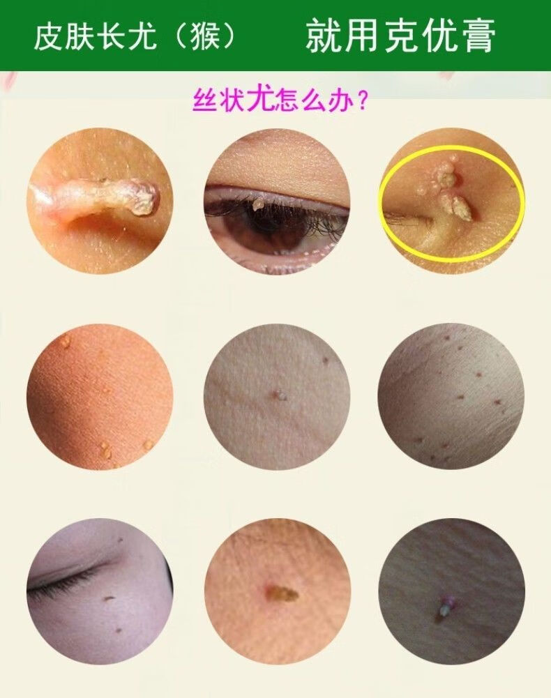【京选美妆】鸦胆子去瘊灵膏氟软膏鸭胆子去瘊灵去除疣滴灵净 一盒装