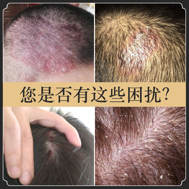 治i療頭皮毛囊炎神器全身背手臂痘痘膏去雞皮膚疙瘩毛囊堵塞角質薬單