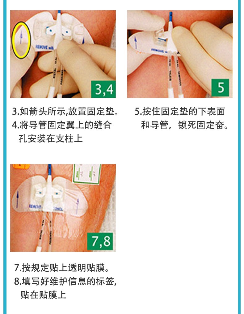 蝴蝶型体表导管固定装置 思乐扣picc中心静脉导管固定器 胆汁胆道管