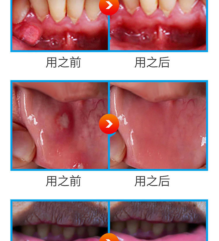 口腔潰瘍潰爛複發性治口瘡爛舌頭嘴巴口舌生瘡上火起泡爛嘴巴一盒體驗