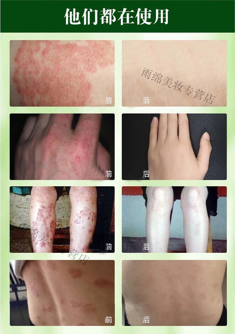 菩清堂菩清堂草本乳膏肛门瘙痒止痒膏阴囊私处大腿内侧屁股普清堂