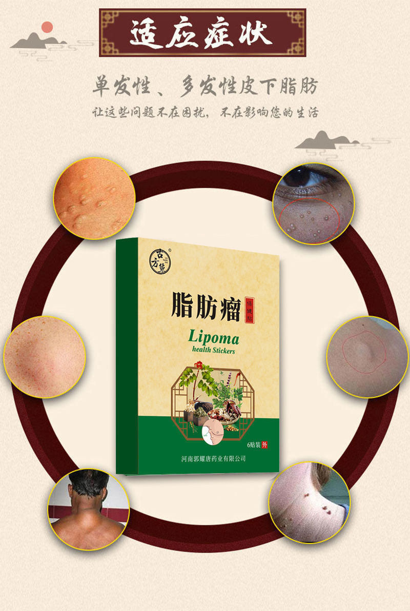 皇尚凰脂肪瘤脂肪瘤消贴皮下脂肪瘤肿块硬块多发性皮下囊肿脂肪瘤专用