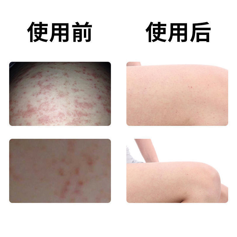 专治痱子热痱子喷雾婴儿成人专用去痱子水祛瘙痒灼热疼痛痱子三盒装