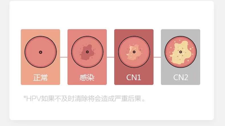 hpv转阴 抗hpv生物敷料宫颈高危转阴yao转阴hpv干扰素感染52 白色