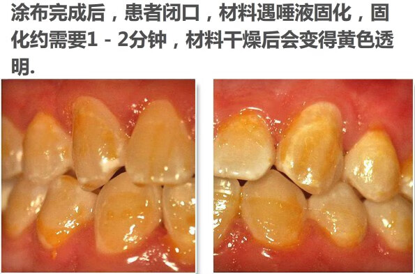2022年新款进口高露洁多乐氟duraphat护齿涂氟剂蛀牙脱矿儿童成人单次