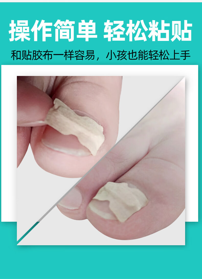 免胶水甲沟炎器嵌甲正甲贴拉拉脚趾贴片50枚/2盒 甲沟炎专用药【图片