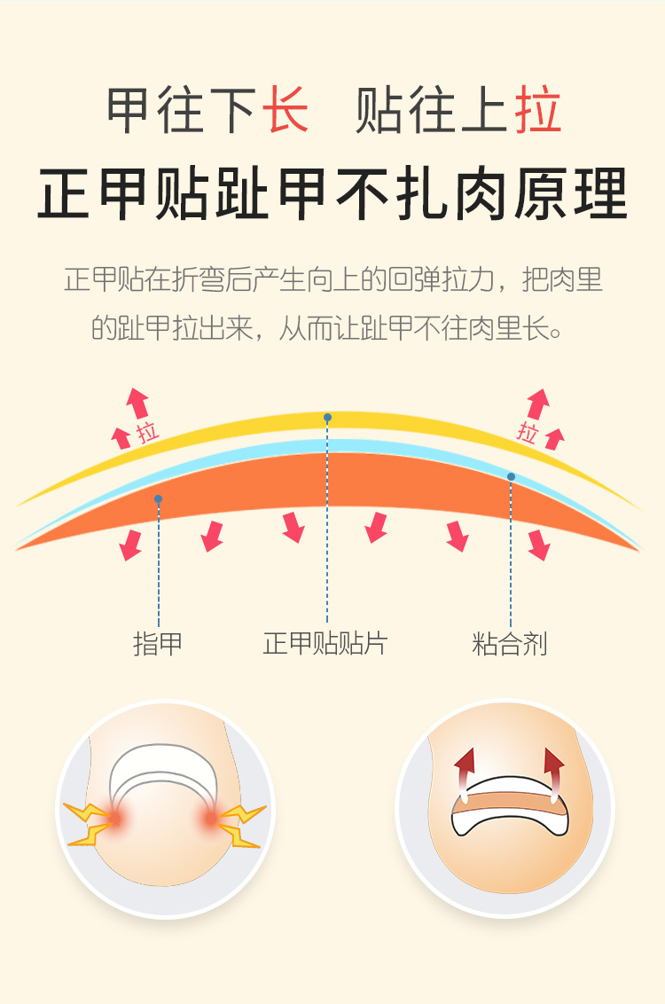 药房直售 甲沟炎器正甲贴脚趾甲甲沟嵌甲专用器贴片指甲长到肉里脚