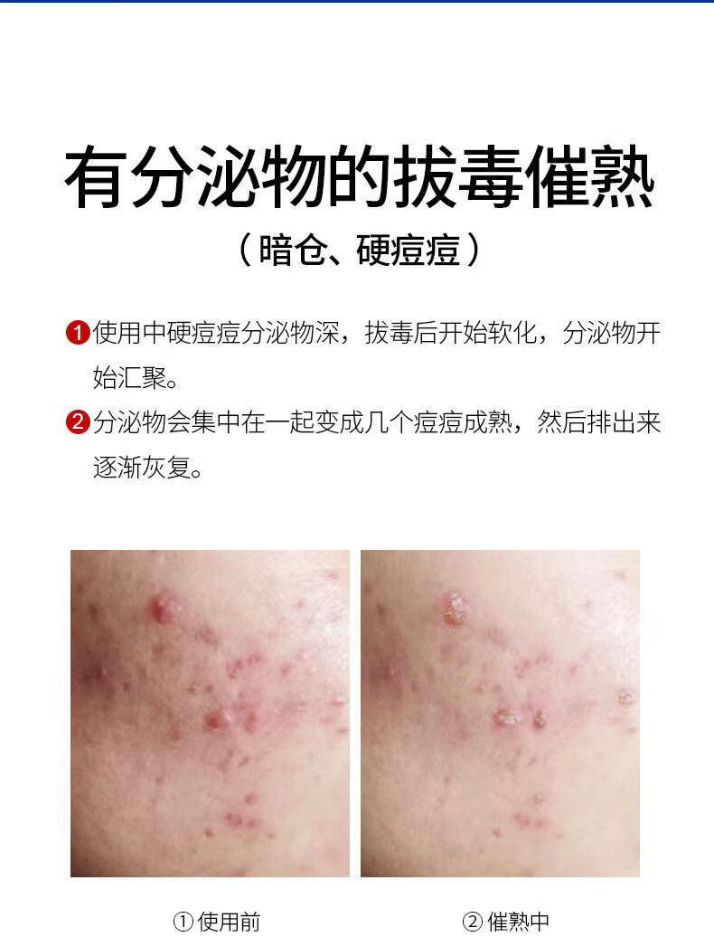 痘印痘坑修復洗面奶痘膏黑頭粉刺控油蟎蟲潔面乳痘膏