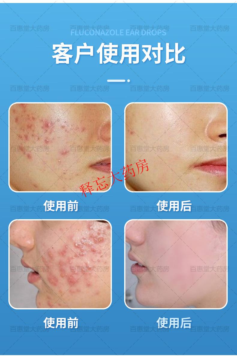 复方氯霉素酒精溶液洗液氯霉素酊痘痘氯柳酊水氯酊擦剂 水氯酊擦剂