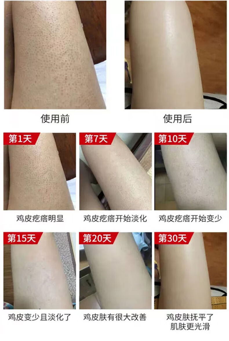 鹤叔讲鸡皮肤痒(鸡皮肤鹤叔治疗方法)