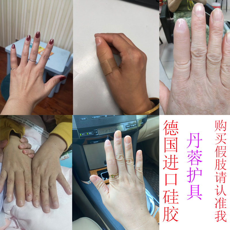 汁寒磐假肢假手指仿真脚趾残疾人义肢半指德国进口硅胶美容手套量身