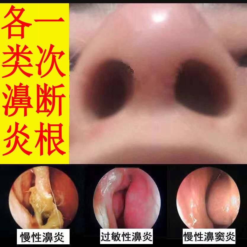 鼻窦ii炎鼻息ii肉过敏性鼻炎鼻塞流鼻涕打喷嚏苗灵鼻炎膏买二一发3盒