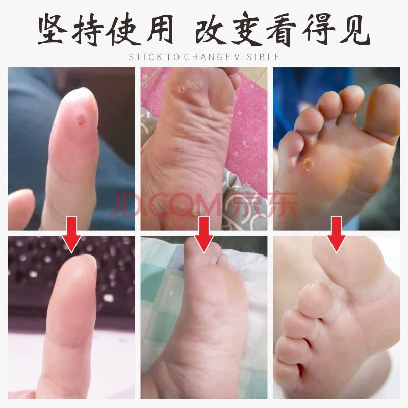 健医师足贴(鸡眼专用型)